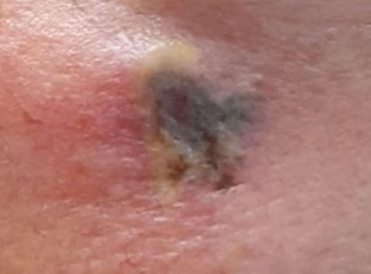 Pensano sia un eczema ma è un tumore alla pelle 