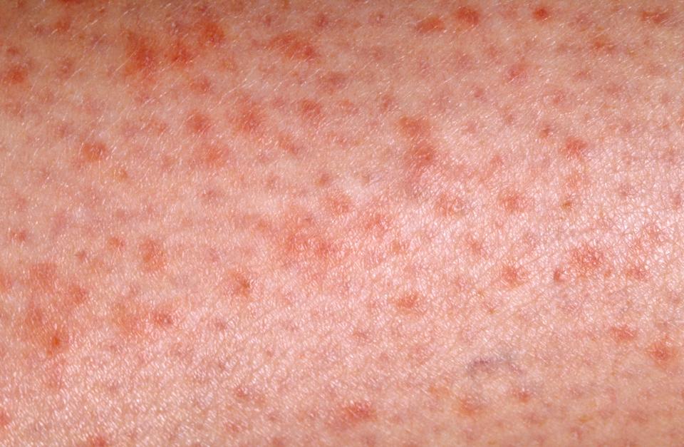 irritazione della pelle con prurito