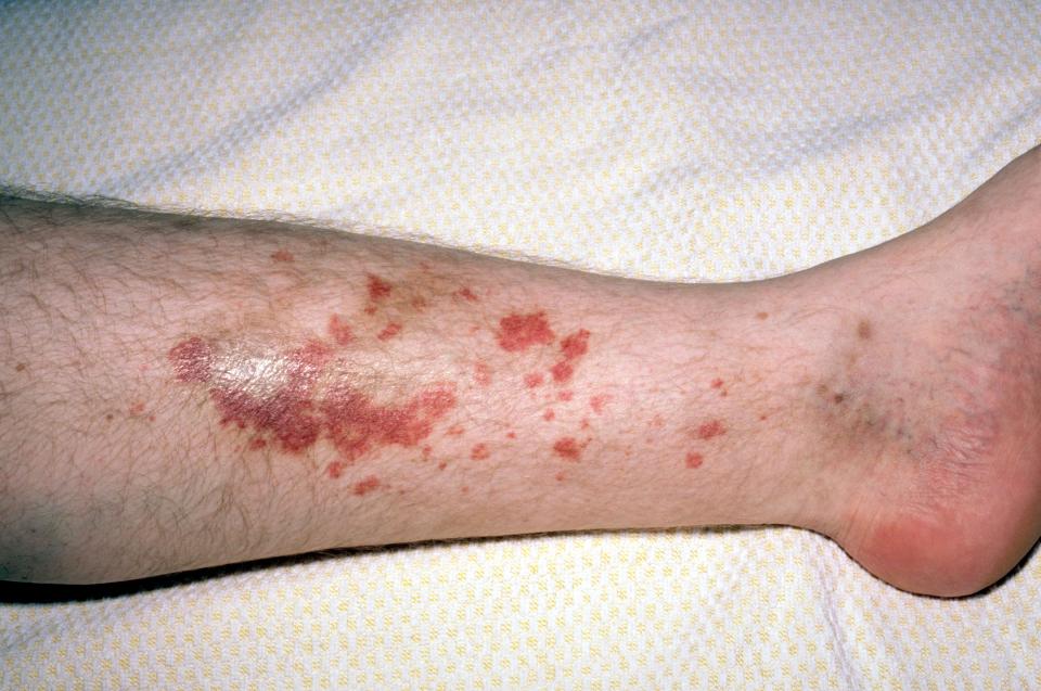 irritazione pelle gambe