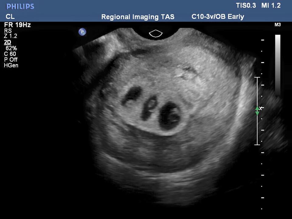 Беременность 4 недели видна на узи. Снимок УЗИ беременности 4-5 недель двойня. Беременность тройней УЗИ 5 недель. УЗИ многоплодной беременности 5 недель фото. УЗИ на 5 неделе беременности двойня.