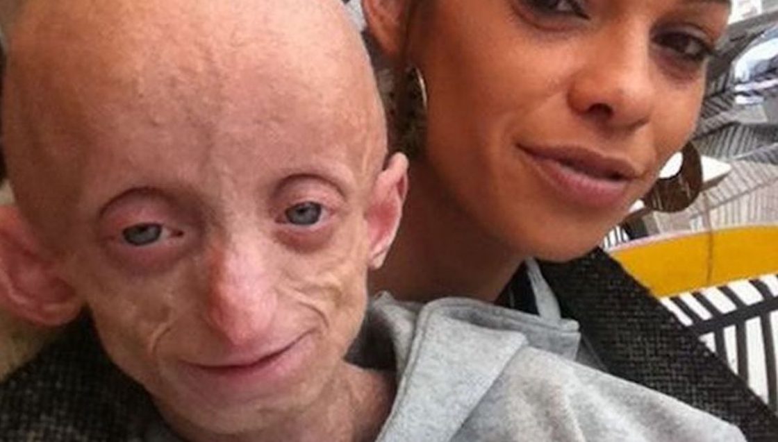 Ashanti Smith morta progeria malattia Benjamin button