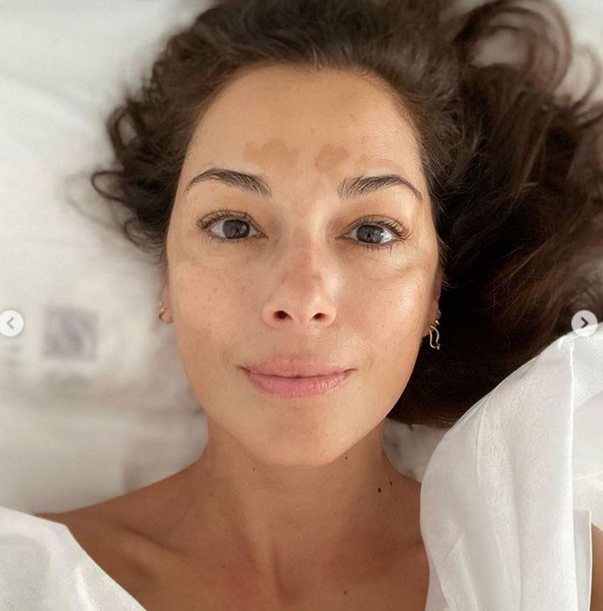 giorgia surina macchie pelle