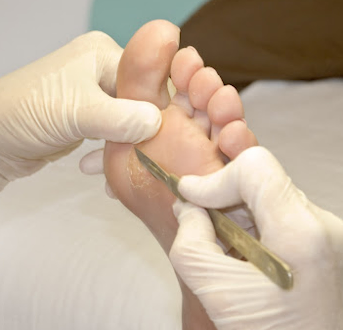 Clara Shellman gamba amputata pedicure