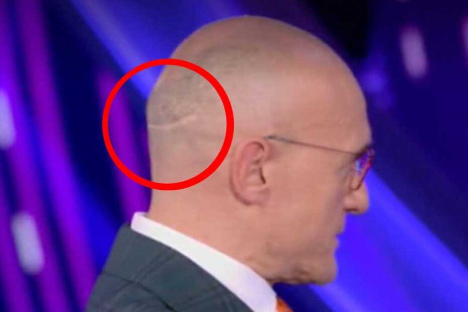 Alfonso Signorini cicatrice nuca trapianto capelli