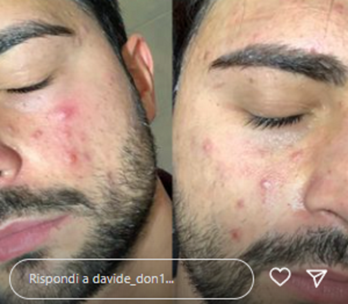 Davide Donadei viso rovinato problema salute acne ex tronista UeD