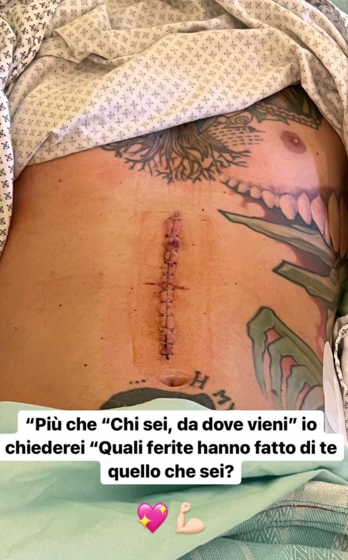 fedez cicatrice operazione come è oggi