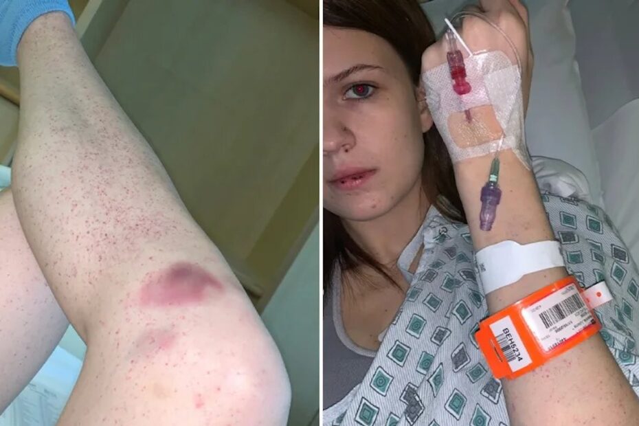 Juliana Pascarella affetta da trombocitopenica idiopatica