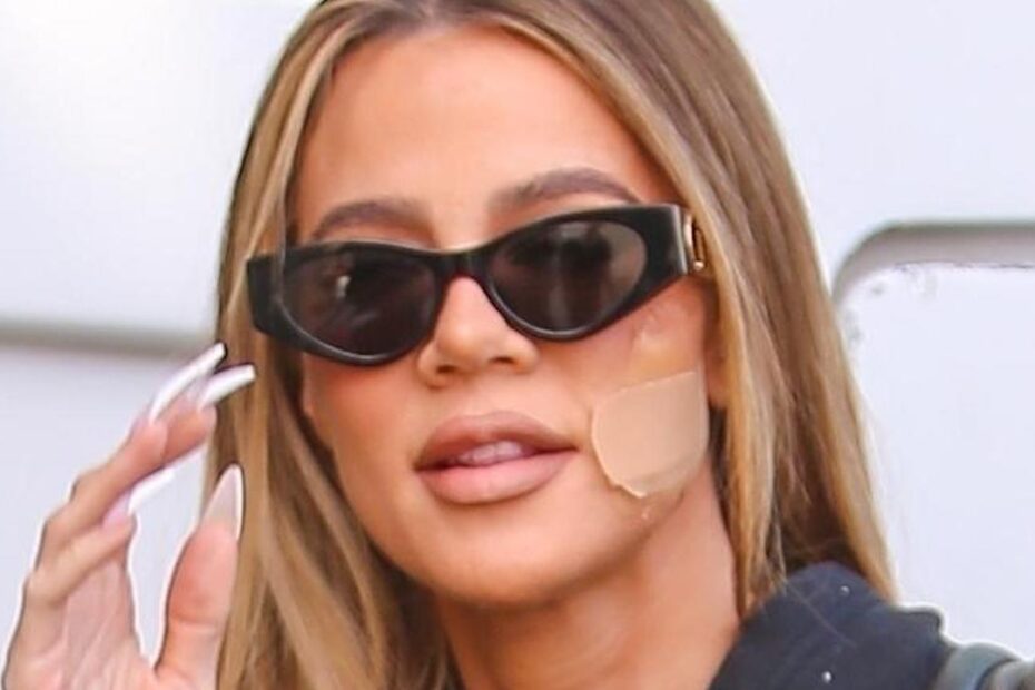 Khloe Kardashian tumore cerotto guancia