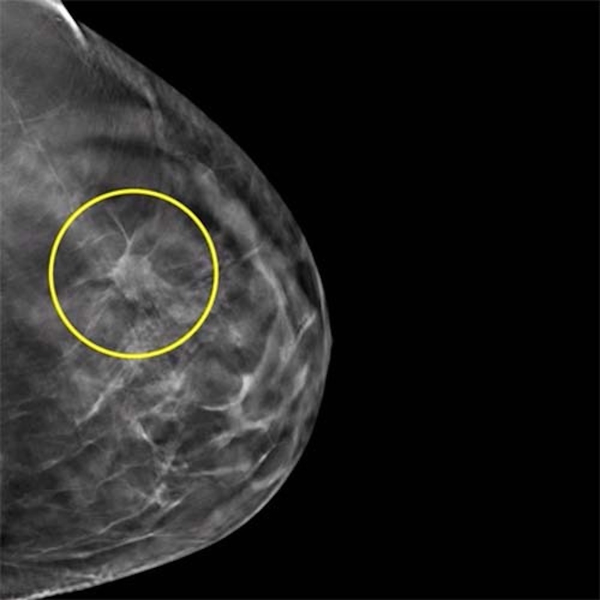 Tumore al seno diagnosticato dopo dolori al petto e asma