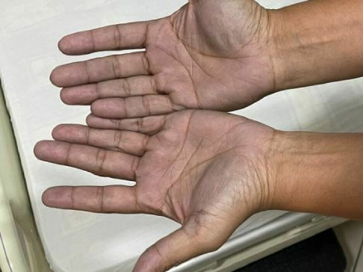 mani blu ospedale diagnosi 