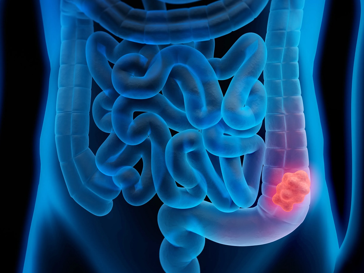4 sintomi del tumore al colon-retto