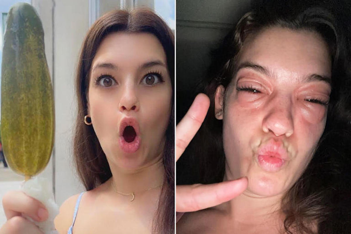 Va a una sagra e si scatena una reazione allergica, 28enne in ospedale