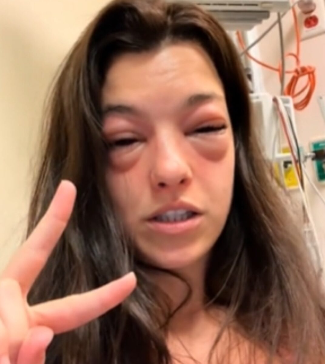 Va a una sagra e si scatena una reazione allergica, 28enne in ospedale