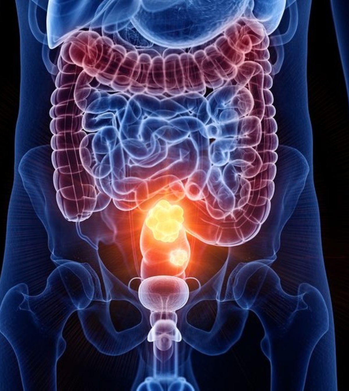 cancro colon retto si può prevenire